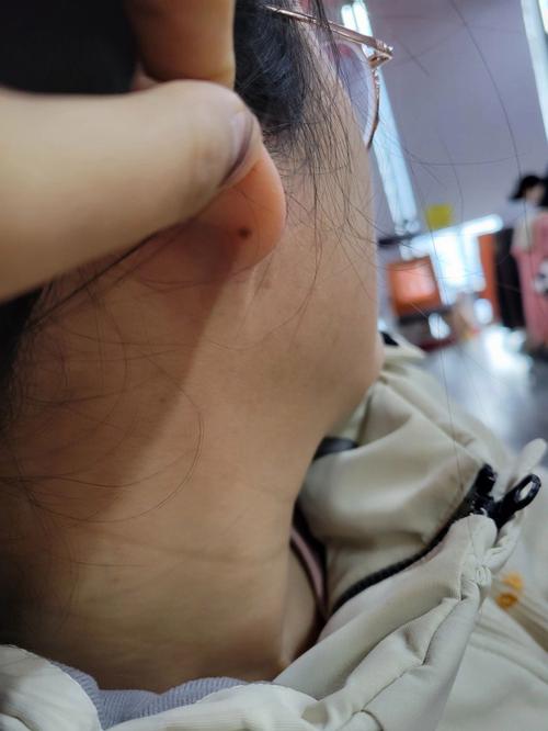耳垂反面有痣代表什么 好不好