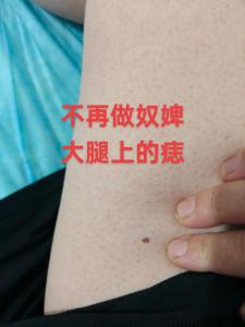 腿上突然長痣要當心 注意防范小人避開危機