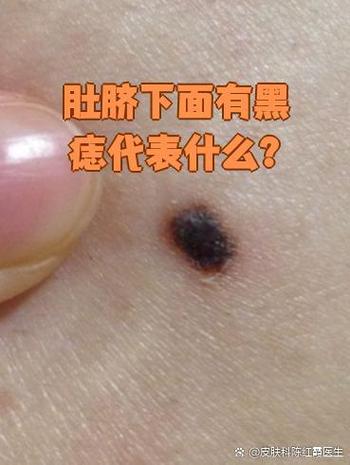 男人肚臍下面有痣 男的肚臍眼下面有顆痣好不好