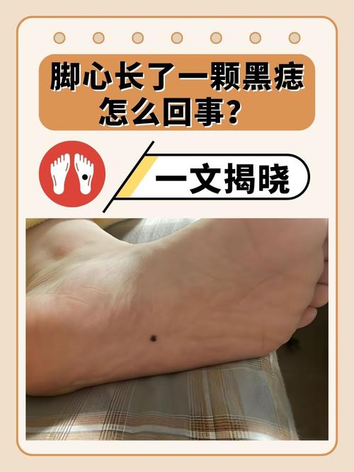 男孩左腳底長痣好不好 男人的左腳腳底心有一顆有痣代表什么