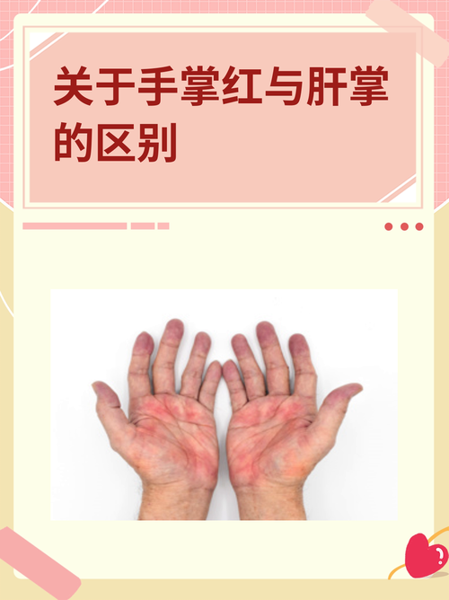 朱砂掌手相特征 朱砂掌與肝掌的區別是什么