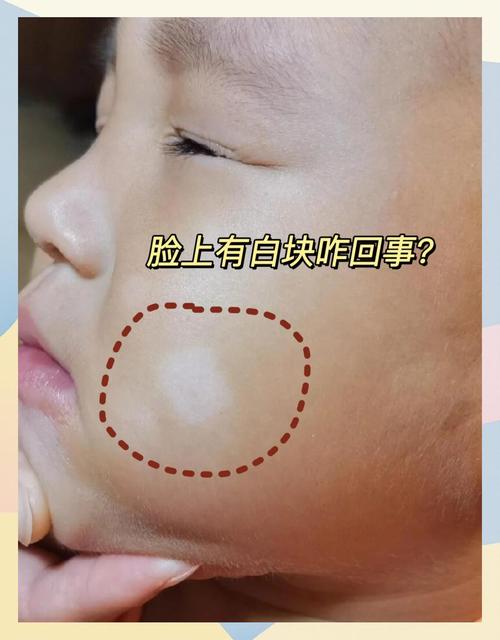 白色胎記好不好