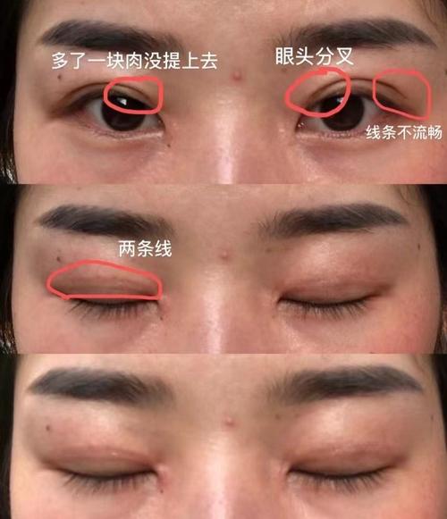 割雙眼皮影響運(yùn)氣嗎