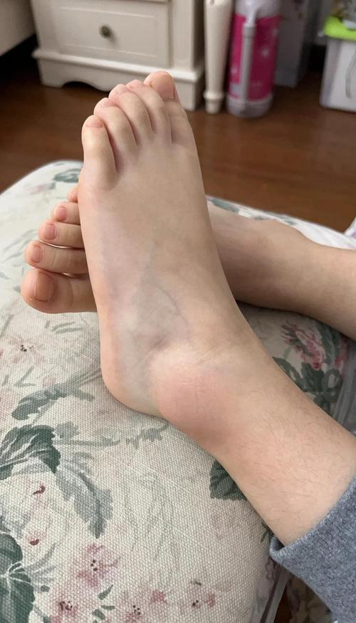 腳脖子上有傷的人運氣好嗎