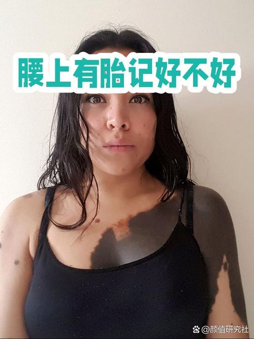 腰部有胎記好不好