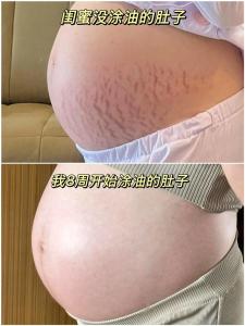 妊娠線變淺是怎么回事