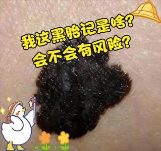 黑色胎記有什么意義