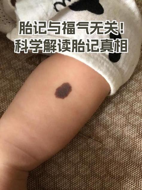 你的胎記在哪里？看你是什么命！