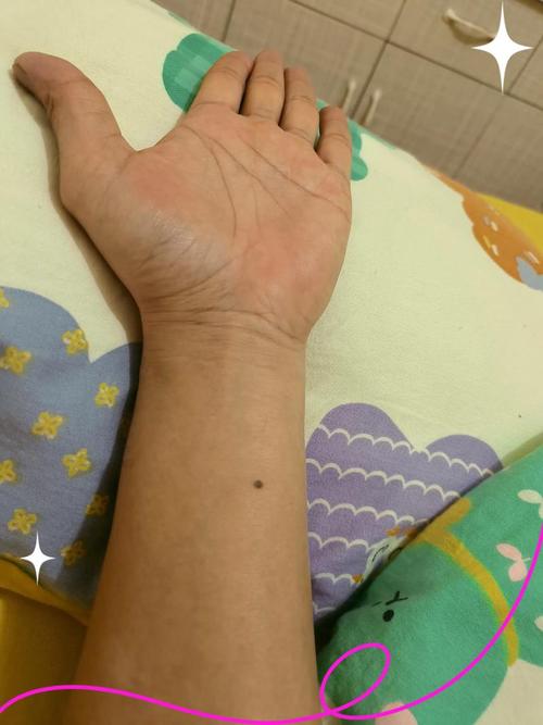 左手朱砂痣位置 左邊胳膊事業旺盛