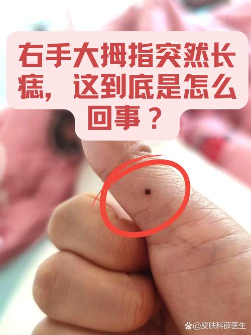 右手大拇指上有痣 大拇指突然長了一顆痣的女人代表什么