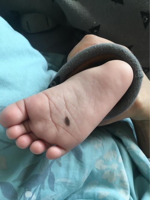 寶寶腳底長痣 小孩腳底突然長了個黑痣好不好