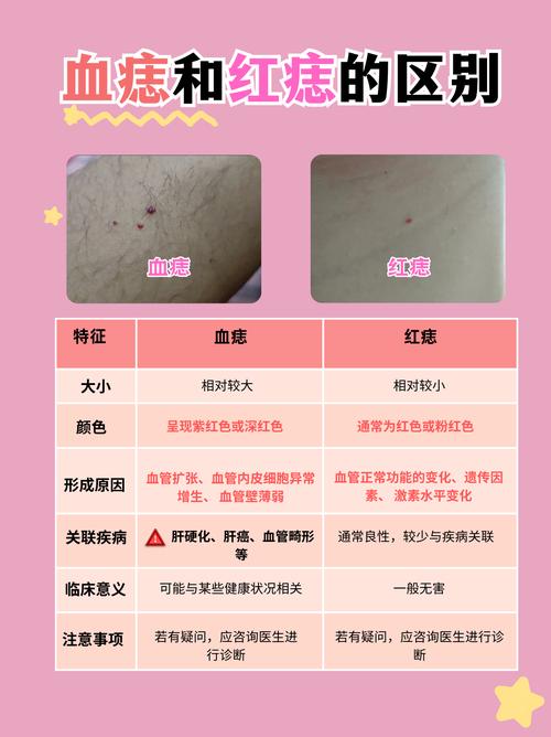 紅痣和血痣的區別 怎樣辨別紅痣和血痣