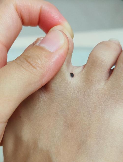 女人腳趾上大腳趾頭縫里有痣 腳趾長痣代表什么