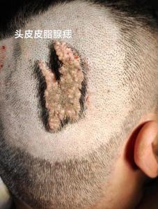 男孩頭頂上有痣 頭上長(zhǎng)肉痣的男人代表什么好不好