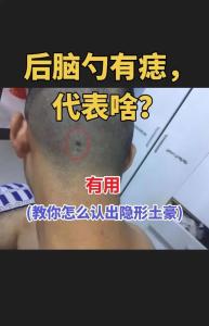 后腦勺長痣的人的運程 后腦勺有痣代表什么