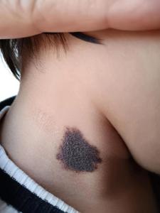 據(jù)脖子上胎記算命，有什么說(shuō)法
