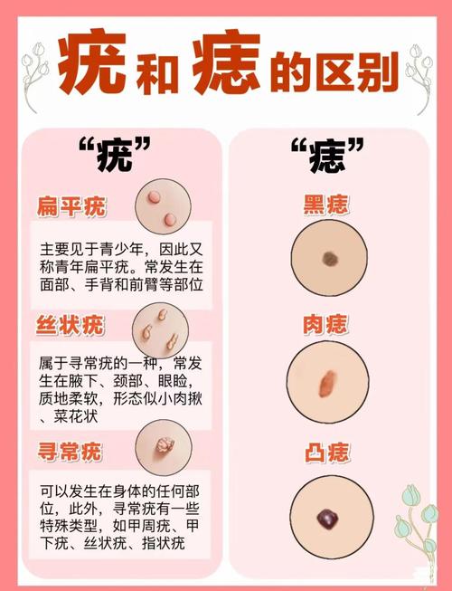 痦子和痣的區(qū)別