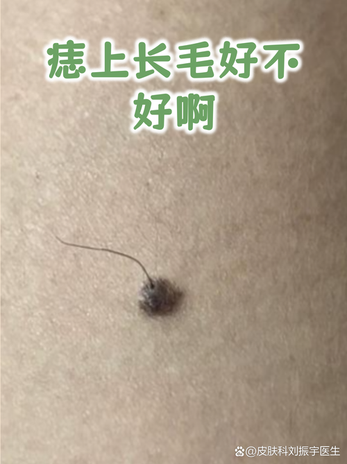 痣上長白毛代表什么 痣上長白毛好不好