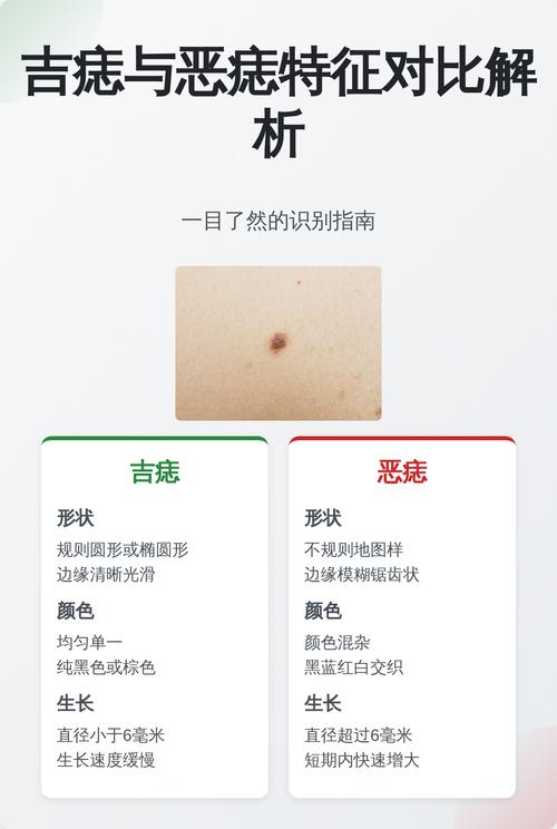 什么是惡痣什么是善痣 善痣和惡痣的區別詳解