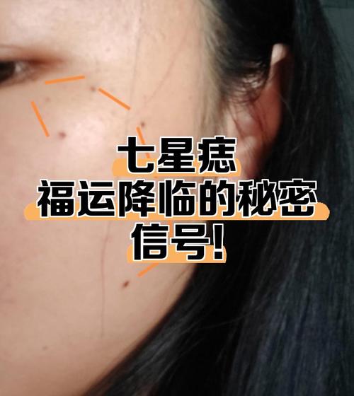 臉上長有北斗七星痣代表什么好嗎 護體七星痣的人好處