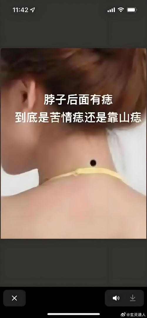 女孩后腦長痣代表什么 女人后腦長痣好不好