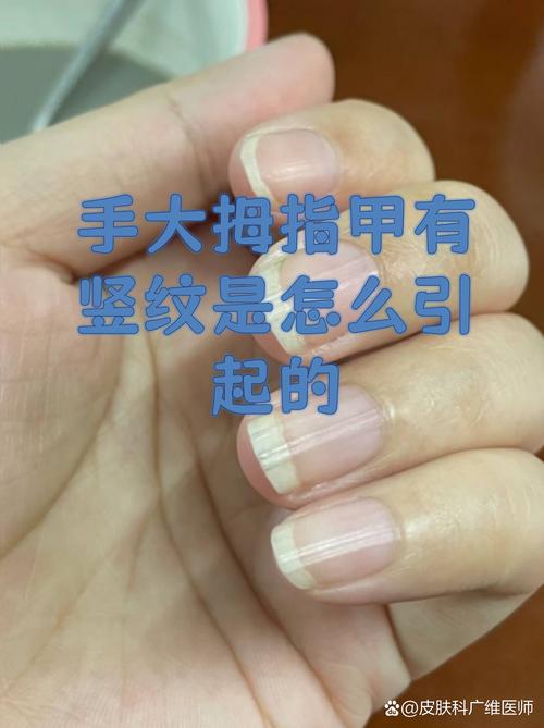 指甲上有豎紋是怎么回事