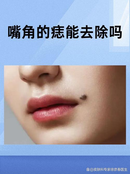 嘴唇痣能不能點掉？