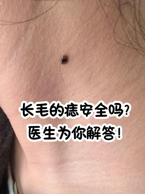 痣上長毛是什么意思 具體分析痣上長毛好不好