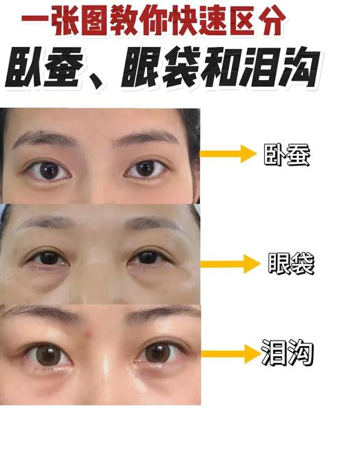臥蠶的位置在哪里，臥蠶與眼袋的區(qū)別