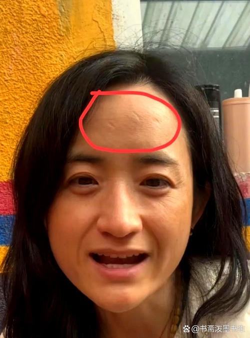 女人額頭有疤真的會(huì)命苦嗎 不宜有疤痕的部位是哪里