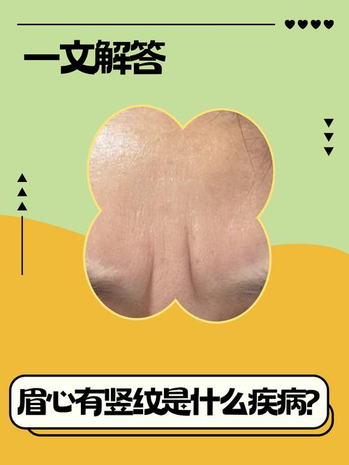 女人眉間有一條豎紋什么面相 預防方法如何解析