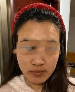面部黃腫：面相學氣色發黃、皮膚發黃、黃腫命理