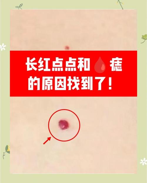 紅痣面相好不好 臉上長紅色痣怎么回事