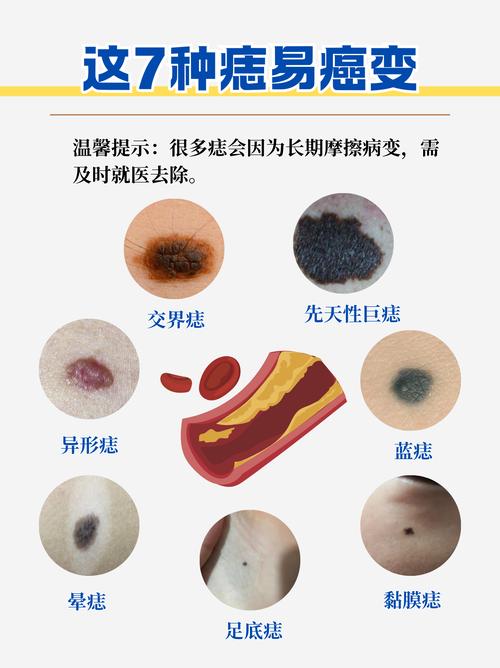 痣分幾種