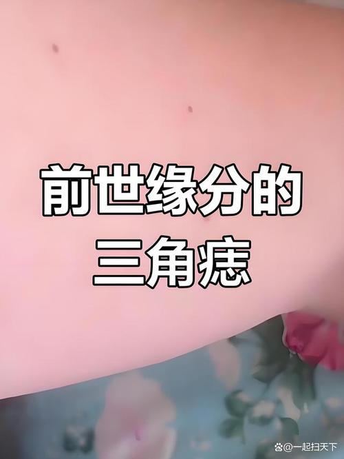 三痣相連易瘋魔嗎