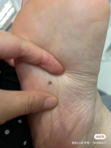 腳底長痣的男人是不是前途無量