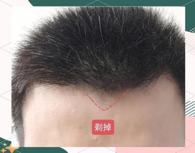 美人尖剃掉會如何 影響運勢嗎