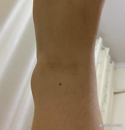注定成功女人痣 腳踝痣事業(yè)有成