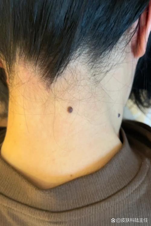 女生男人脖子后面有痣代表什么 脖子后面兩顆痣
