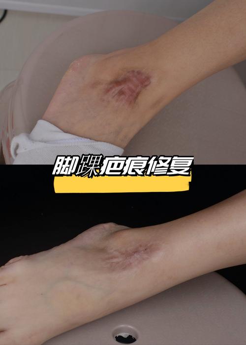 腳踝有疤痕運(yùn)勢(shì)怎么樣