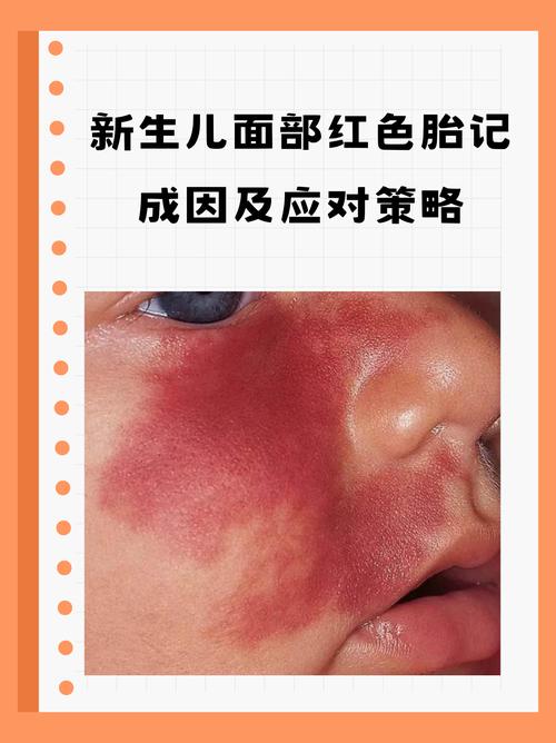 紅色胎記好嗎