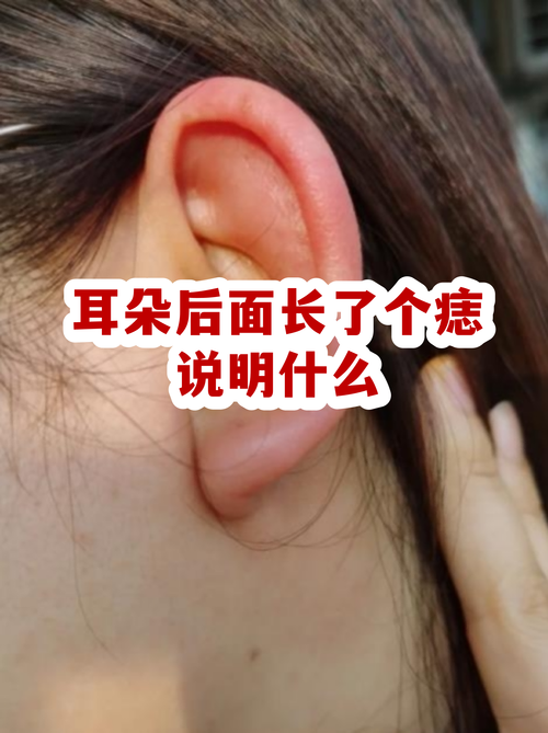 右耳朵后面長的痣好嗎 女人耳朵后面有痣代表什么