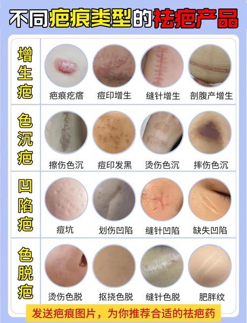 身體有疤痕會影響財運嗎