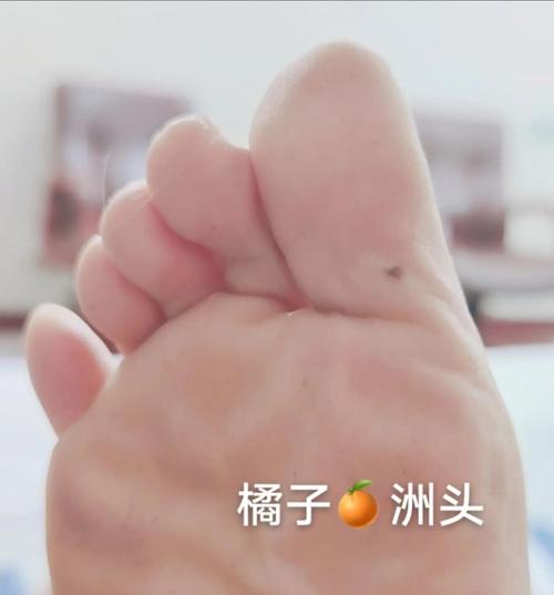 腳大拇指有痣代表什么 右腳大拇指有痣代表什么