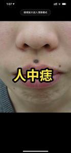 女人人中有痣易出軌是真的嗎