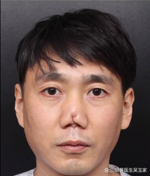 鼻子有疤的男人會招小人嗎
