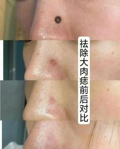 大顆凸起肉痣怎么去除