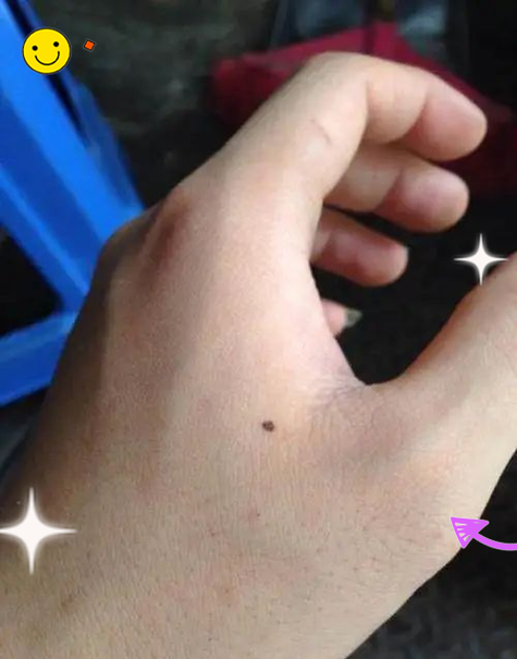 女孩左手虎口突然長痣