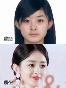 整容能改變?nèi)说拿嫦嗟芨淖內(nèi)说倪\(yùn)勢(shì)嗎?(一)