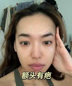 面相分析額頭有疤好不好？